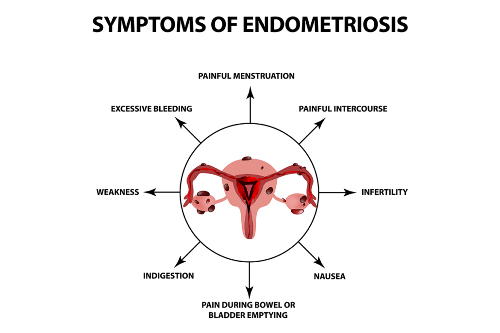 Endometriosis: Endo Symptoms, Diagnosis, Treatment | MyObMD