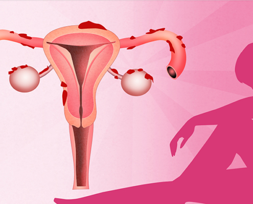 Endometriosis-Symptoms, Diagnosis, Treatment