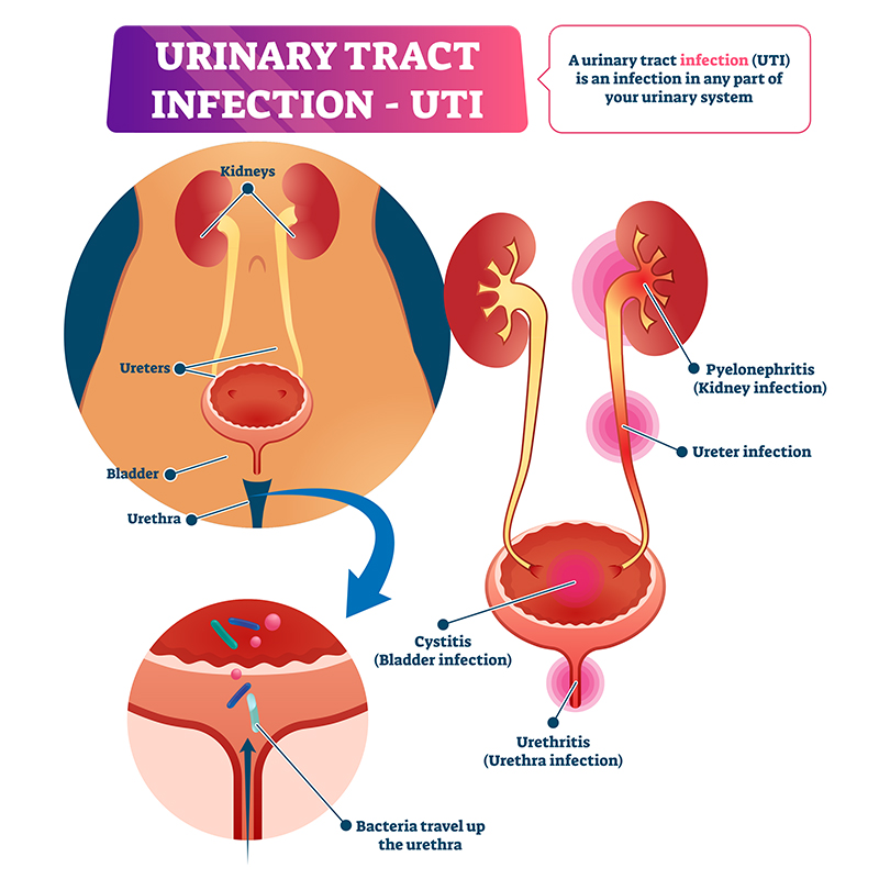 Urinary-Tract-Infection-(UTI)