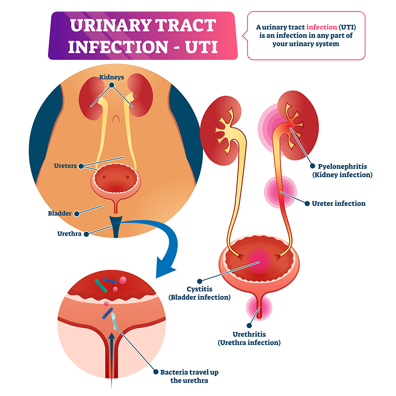 Urinary Tract Infection (UTI): Symptoms, Diagnosis & Treatment