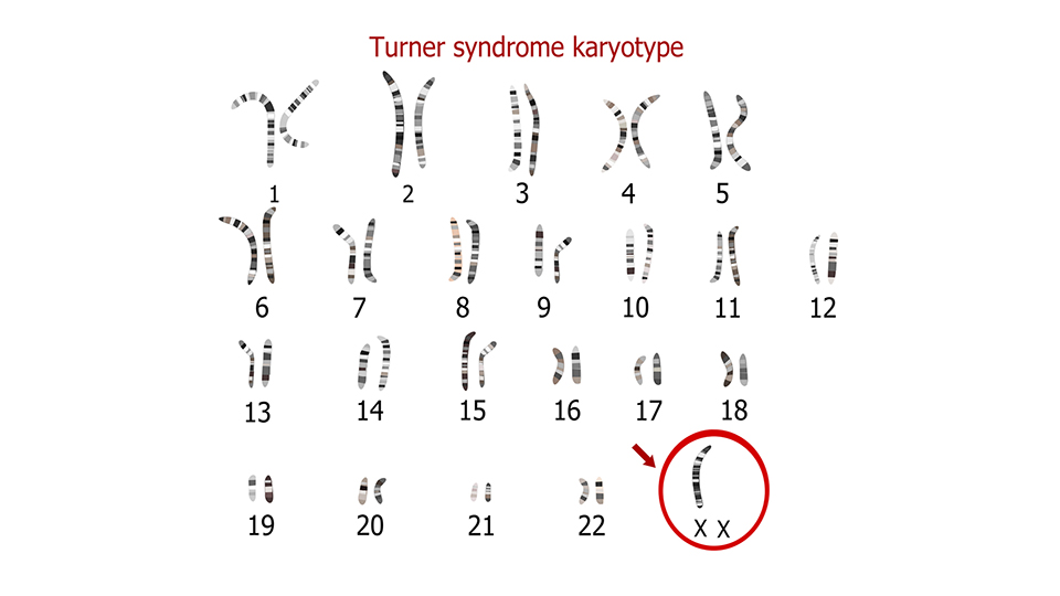 Turner Karyotype