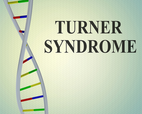Turner Syndrome-More Than a Missing-X