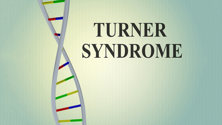 Turner Syndrome More Than A Missing X MyObMD Turner Syndrome More Than A Missing X MyObMD