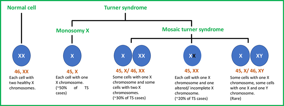 Turner-Syndrome